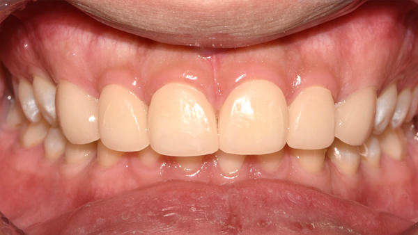 치료 후 이미지