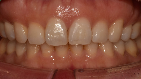 치료 후 이미지