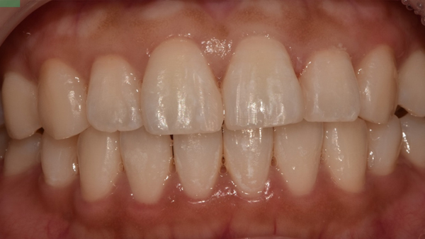 치료 후 이미지