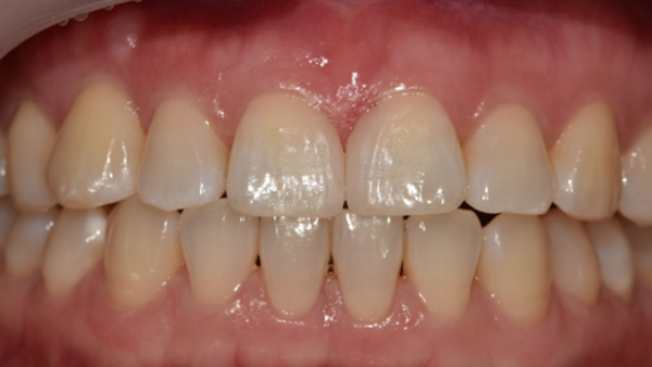 치료 후 이미지