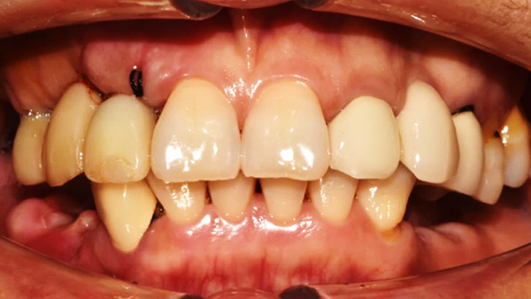 치료 후 이미지