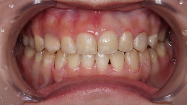 치료 후 이미지