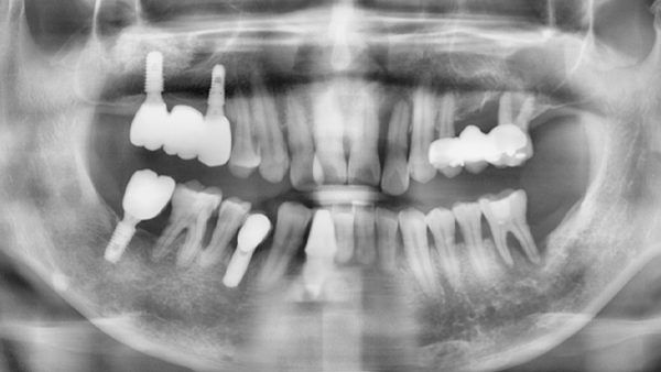 치료 후 이미지