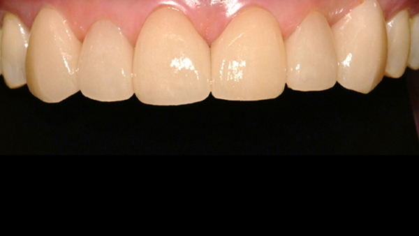 치료 후 이미지