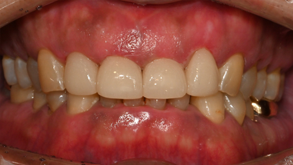 치료 후 이미지