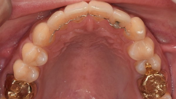 치료 후 이미지