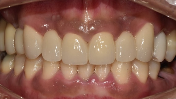 치료 후 이미지